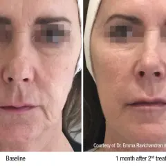 Före- och efterbilder visar en kvinna som genomgått en profhilo behandling. Huden ser slätare ut efter behandlingen.