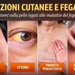 Eruzioni cutanee e ittero, sintomi di malattie epatiche. L'arrossamento cutaneo, macchie rosse e prurito persistente possono indicare problemi al fegato.