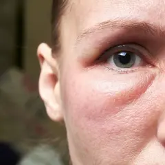 Obrzęk wokół oka, zaczerwienienie i widoczne pory na policzku sugerują twarz kortyzolową, oznakę stresu lub problemów zdrowotnych.