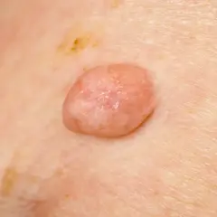 Zmiana skórna, widoczna na zdjęciu, może być jednym z objawów wirusa HPV.