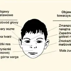 Ilustracja twarzy dziecka z zaznaczonymi cechami, jak mały obwód głowy, płaska twarz, krótki nos, wąska warga, zmarszczka nakątna, zapadnięty grzbiet nosa, zniekształcenie małżowin uszu, mała żuchwa. To mogą być objawy z zespołu FAS.