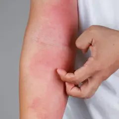 Nietolerancja fruktozy objawy skórne - rzadkie symptomy, które zaskakują