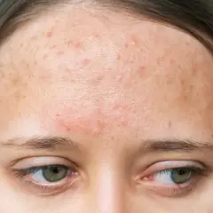 Alergia na mleko u dorosłych: objawy skórne, diagnoza i leczenie