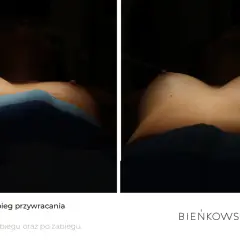 Trwałość lipofillingu biustu: Ile tłuszczu zostanie z Tobą na lata?