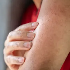 En hand undersöker en arm med en knottrig panna, troligen ett utslag eller torr hud.