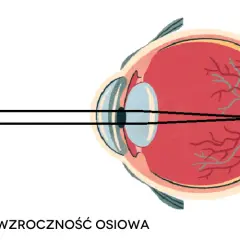 Czy wada wzroku minus może się cofnąć: Prawda o leczeniu krótkowzroczności