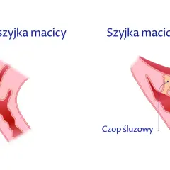 Jak skutecznie zapobiec skracaniu szyjki macicy w ciąży i uniknąć zagrożeń