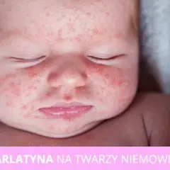 Objawy szkarlatyny u niemowlaka – jak rozpoznać i co robić?