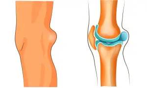 Knie mit Bakerzyste, die eine Schwellung hinter dem Kniegelenk zeigt. Die rechte Seite illustriert das Kniegelenk und die mögliche Bakerzyste, die eine Behandlung erfordert.