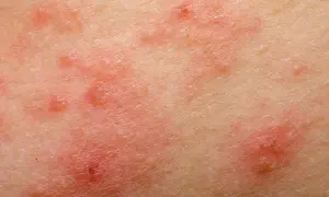 Czy soczewica uczula? Objawy alergii, które musisz znać