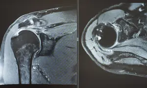 Dwa obrazy rezonansu magnetycznego barku, pokazujące uszkodzenie stożka rotatorów.