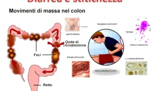 Illustrazione del colon con feci, che mostra movimenti di massa. Diverse cause di diarrea e stitichezza sono elencate, tra cui ipertiroidismo, allergie alimentari e infezioni.