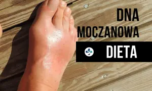 Dna moczanowa: Skuteczna dieta niskopurynowa jedz bez bólu!