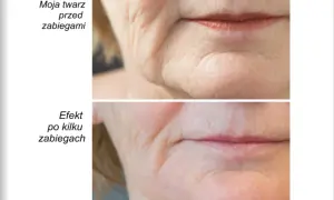 Przed i po terapii manualnej twarzy: widoczne wygładzenie zmarszczek wokół ust.