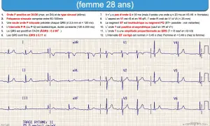 Électrocardiogramme (ECG) d'une femme de 28 ans, montrant un cycle cardiaque normal avec des ondes P, QRS et T caractéristiques.