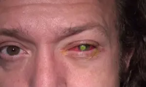 A person's right eye is red and irritated, with a green contact lens visible. This image serves as a stark warning about the dangers of asking "can I sleep with contacts?