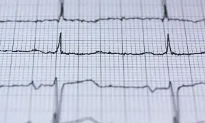 Nieregularne linie EKG na papierze milimetrowym, mogące wskazywać na migotanie przedsionków objawy.