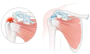 Schulteransicht mit Darstellung einer Tendinopathie der Supraspinatussehne, die entzündet und gerissen ist.