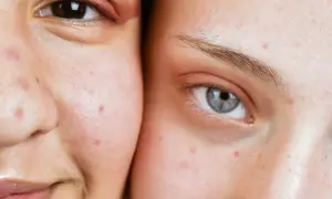 Visages de deux personnes montrant des imperfections cutanées, possiblement des maladies de peau dues au stress.