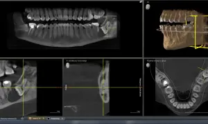 Analiza 3D szczęki z widocznymi 8 zab. Pokazuje przekroje i model 3D.