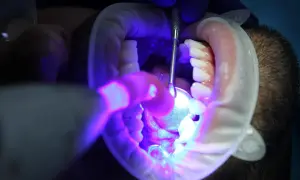 Zatrucie zęba bez leczenia kanałowego. Dentysta bada ząb pod lampą UV, używając narzędzi i rozwieraka.