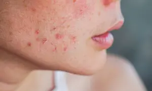Gros plan sur une joue avec des rougeurs et des marques d'acné, suggérant des solutions pour comment enlever les cicatrices de boutons.