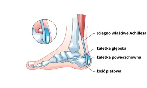 Anatomia pięty: ścięgno Achillesa, kaletki i kość piętowa.