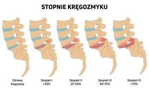 Ilustracja pokazuje stopnie kręgozmyku od zdrowego kręgosłupa do zaawansowanego, gdzie kręgi przesuwają się względem siebie.