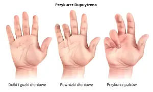 Trzy dłonie ilustrują postępujące stadia przykurczu Dupuytrena: od niewielkich guzków, przez powrózki, aż po zgięte palce.