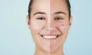 Volto diviso: da un lato pelle liscia e luminosa, dall'altro con brufoli e imperfezioni. Scopri i rimedi per i brufoli fatti in casa per una pelle radiosa.