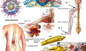 Immagine illustra cause di dolore neuropatico e neuropatia periferica: virus, compressione nervosa, ernia del disco, danni alla mielina.