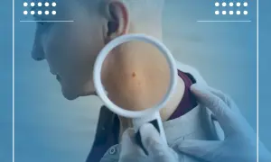 Badanie znamienia na szyi, które może być jednym z objawów raka jelita grubego.