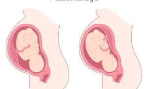 Zwei Darstellungen einer Schwangerschaft: Links eine vorderwand plazenta, rechts eine hinterwandplazenta. Der Fötus ist in beiden Fällen gut erkennbar.