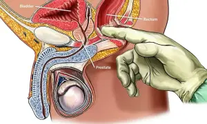 Ilustracja anatomiczna pokazująca badanie per rectum. Dłoń w rękawiczce dotyka prostaty przez odbytnicę.