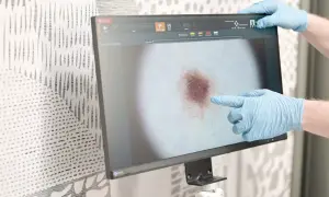 Dermatolog w rękawiczkach wykonuje badanie dermatoskopowe, analizując obraz znamienia na monitorze.