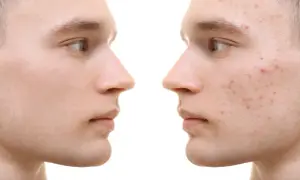 Gesichtsprofil links: reine Haut. Rechts: Akne-Ausbrüche, die durch Omega-3-Fettsäuren verbessert werden könnten.