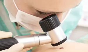 Lekarz bada pieprzyk dermatoskopem. Czy usuwanie pieprzyka boli? Zależy od metody i znieczulenia.