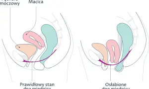 Schemat porównuje prawidłowy stan dna miednicy z osłabionym, pokazując, jak wypadanie macicy wpływa na narządy.