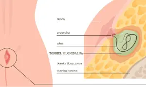 Przekrój skóry ukazujący torbiel pilonidalną z włosiem w środku, otoczoną tkanką tłuszczową i kostną.