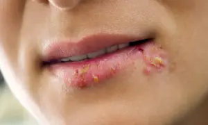Primo piano di un labbro con un brutto brufolo, arrossato e con croste giallastre.