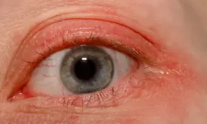Oko z zaczerwienioną powieką i widocznymi naczynkami.