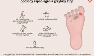 Ilustracja pokazuje sposoby zapobiegania grzybicy stóp: nie chodzić boso, myć stopy, obcinać paznokcie, unikać ciasnych butów, nosić bawełniane skarpety.