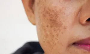 Gros plan sur une joue présentant une hyperpigmentation, avec des taches brunes visibles. Une solution de traitement hyperpigmentation est recherchée.