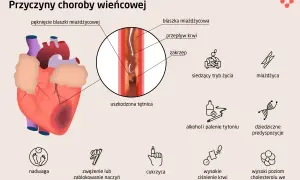 Ilustracja przedstawia serce i czynniki ryzyka choroby wieńcowej: miażdżycę, nadwagę, cukrzycę, wysokie ciśnienie, alkohol, palenie, siedzący tryb życia i predyspozycje genetyczne.