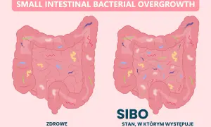 Porównanie zdrowego jelita cienkiego z jelitem w stanie SIBO, gdzie widoczny jest nadmiar bakterii. SIBO objawy mogą być uciążliwe.