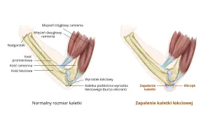 Ilustracja porównująca zdrową kaletkę łokciową z zapaloną, z widocznymi kośćmi i mięśniami.