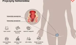 Hemoroidy? Przygotuj się do badania proktologicznego bez stresu!