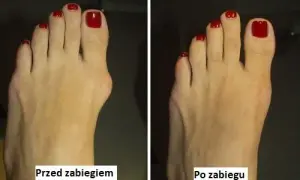 Operacja haluksa: Poznaj metody i odzyskaj stopę bez bólu