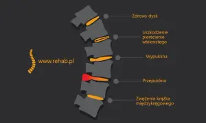 Skręcenie kręgosłupa lędźwiowego: objawy, przyczyny i co robić?