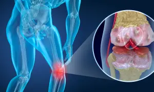 Menschliches Knie mit entzündetem Gelenk. Nahaufnahme zeigt abgenutzten Knorpel, der den Aufbau von Knorpel verdeutlicht.